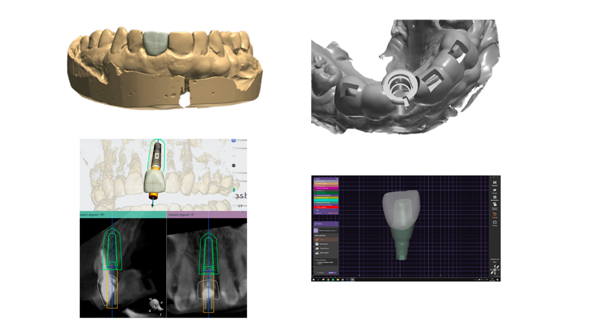 Базовый курс по хирургическим шаблонам.  Basic navigation in dental implantation